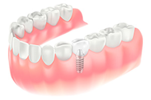 インプラント（埋入〜被せ物まで）